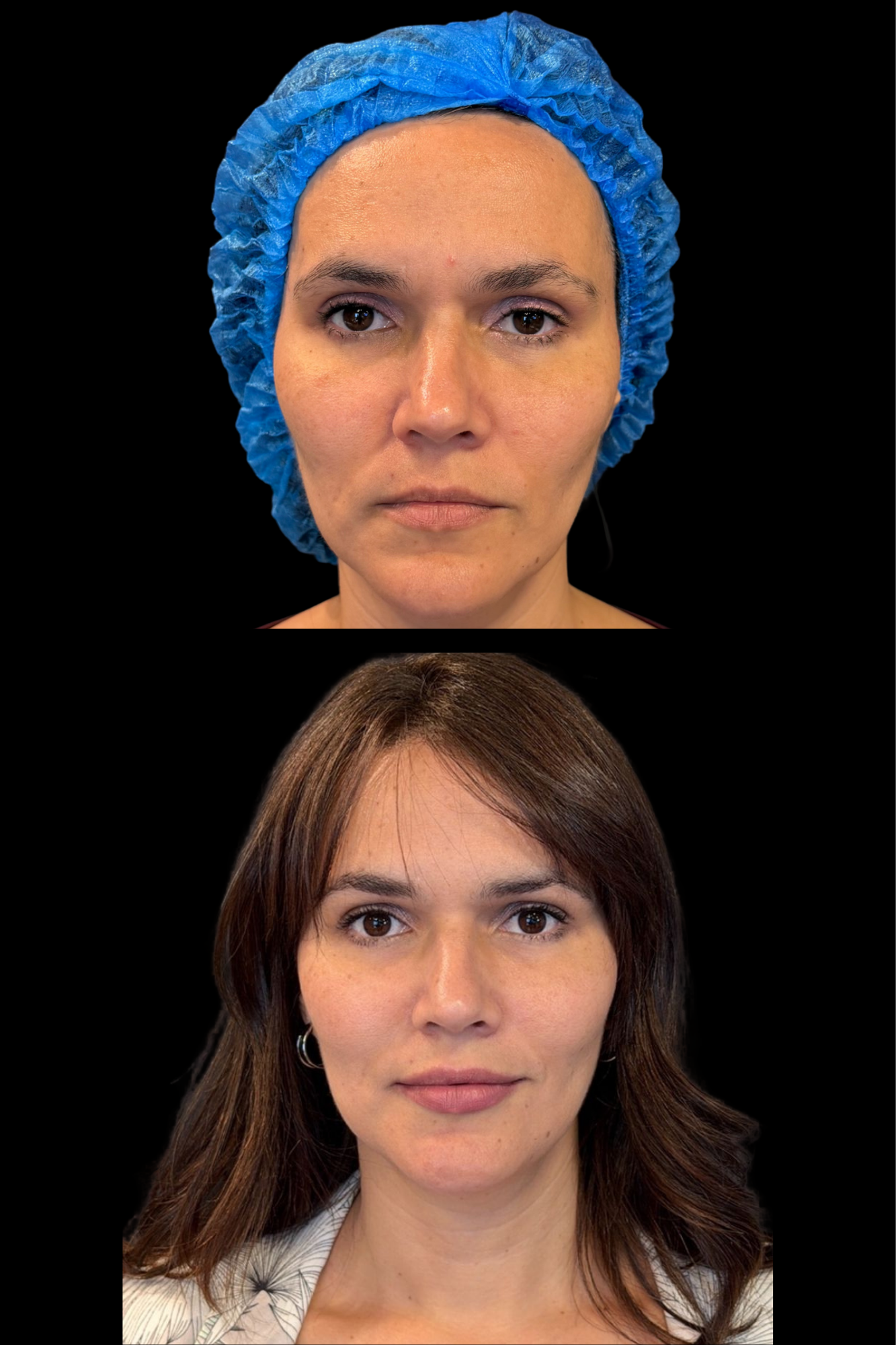 Antes e depois resultado HIPRO